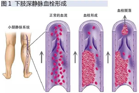 经济舱综合征_经济舱综合征-男子回家坐火车15小时没动 险些没命